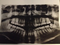 完全な雑記　野村歯を抜く